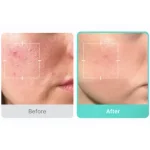 سرم آزلائیک اسید مدیکیوب